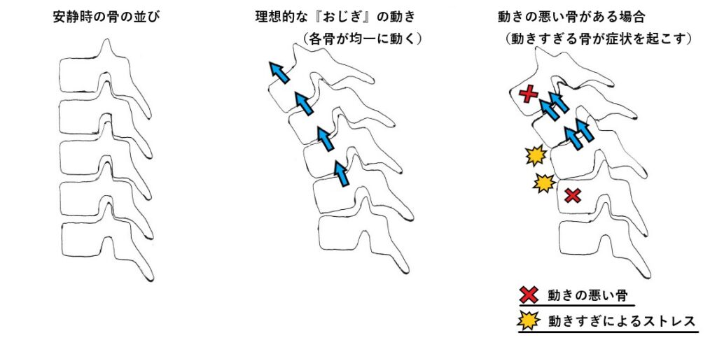 各骨が均一に動く理想的なおじぎはストレスが加わらない
しかし動きの悪い骨がある場合のおじぎは、均一に動くことが出来ずにストレスが加わる